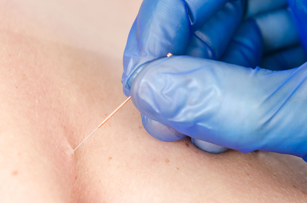 Dry Needling